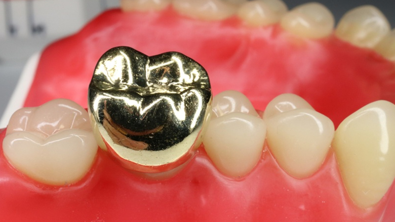 実家の整理で見つかるかも？意外な資産となる「金歯」の価値と売却方法